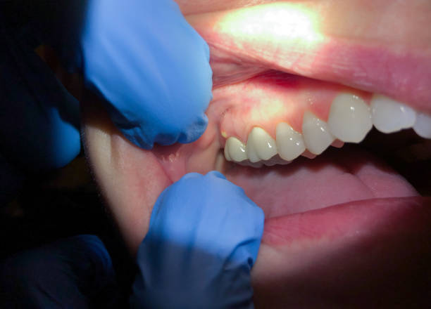 Best Emergency Dental Extractions in Inverness, IL